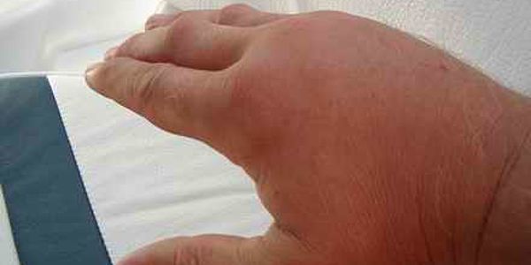 Verletzung Petermaennchen Ceb