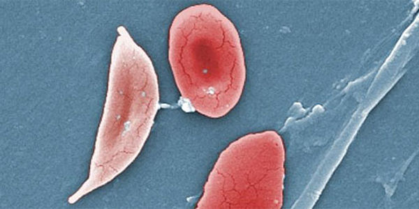 Abb  Sichelzellanaemie Zelle Deb